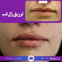 تزریق ژل لب در کلینیک ارکیده