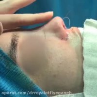 فیلم جراحی بینی طبیعی