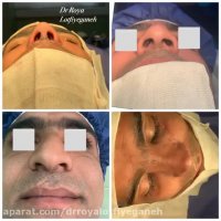 جراحی بینی در مردان