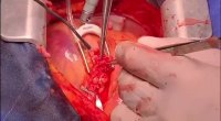 فیلم عمل قلب باز از اول تا اخر