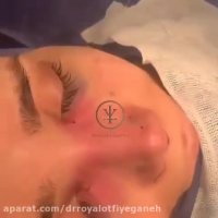 نمونه کار جراحی بینی دکتر رویا لطفی یگانه