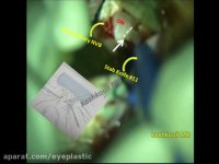 فیلم جراحی سوراخ کردن عصب بینایی توسط پروفسور کشکولی | فوق تخصص جراحی پلاستیک چشم