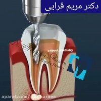 عصب کشی دندان چقدر طول می کشد؟