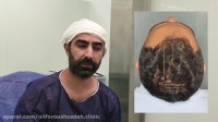 رضایت مراجع کاشت مو در کلینیک دکتر نیلفروش زاده