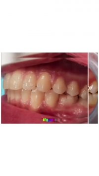 نمونه ارتودنسی | دکتر سیدحامد محمودهاشمی