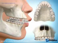 ارتودنسى با كشیدن دندان فك بالا دكتر مهدى فهیمى