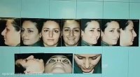 جراحی بینی استخوانی توسط دکتر امید ابراهیمی بهترین جراح بینی