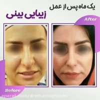 جراحی بینی گوشتی