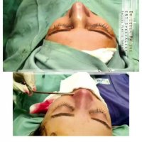 جراحی بینی طبیعی بلافاصله بعد از عمل