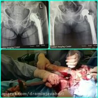 عمل جراحی تعویض مجدد مفصل لگن