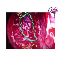 تصادف وجراحی بیمارضربه مغزی