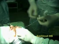 فیلم عمل جراحی آندوسکوپی انسداد مجرای اشکی با بالون | پروفسور کشکولی