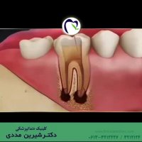 فیلم عصب کشی دندان