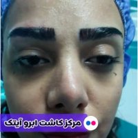 کاشت ابرو روش fut | کلینیک آیتک | 44221324-021