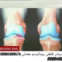 روماتیسم چیست و چند نوع است؟درمان قطعی این بیماری چیست؟(متخصص:امیری)