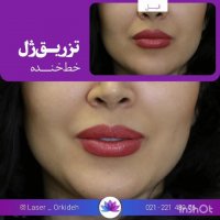 تزریق ژل لب و خط خنده در کلینیک ارکیده