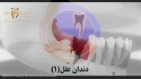 جراحی دندان عقل (بخش اول)