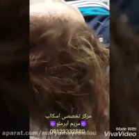 درمان قطعی ریزش مو در خانم ها