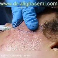 تزریق ژل به گونه