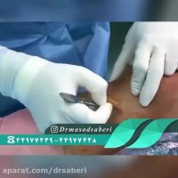 منظور از عمل رباط صلیبی به صورت بسته(لیزری) چیست؟