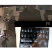 کشیدن جراحی سینوس و کاشت سه ایمپلنت به صورت همزمان