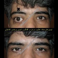 گفتگوی رادیویی پروفسور کشکولی درباره تومورهای حدقه