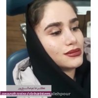 نتیجه جراحی بینی بعد از 5 ماه
