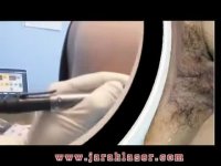 درمان بواسیر یا هموروئید با اسکلروتراپی