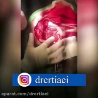 جراحی خارج کردن کانون تشنج