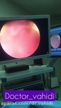 جراحى تومور مثانه