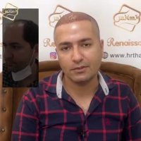 جدیدترین روش کاشت مو