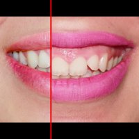 ارتودنسی بدون کشیدن دندان | دکتر داودیان