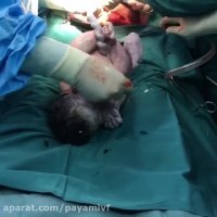 سزارین دو قلوهای شیرین