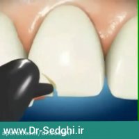 کامپوزیت دندان