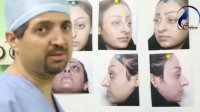 فیلم واقعی جراحی بینی گوشتی