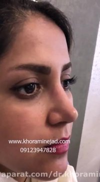 اقدامات بعد از جراحی بینی