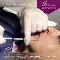 زاویه سازی فک وصورت با تزریق چربی