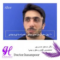 فیلم گرفتگی شدید بینی و انحراف ظاهری