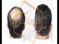 کاشت مو به روش SUT مرکز مو رنسانس