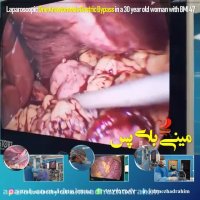 مینی بای پس در خانم 30 ساله