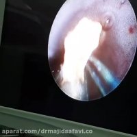 درمان آندوسکوپیک سنگ