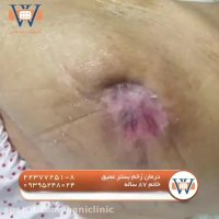 درمان زخم بستر در سن بالا