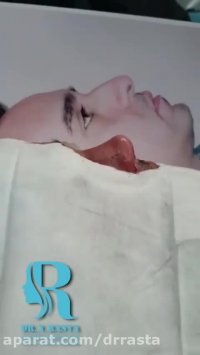 فیلم عمل بینی در مردان