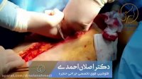 آقای 68ساله با سرطان وسیع bcc عود کرده