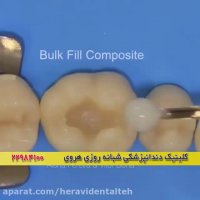 پیشگیری از پوسیدگی دندان و خرابی دندان با ترمیم به موقع دندان