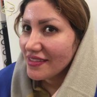 کاشت ابرو | کلینیک تخصصی رنسانس  02122088210