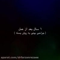 نمونه ای از جراحی بینی نیمه فانتزی به روش بسته