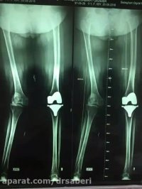 تعویض مفصل زانو