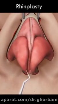 انیمیشن جراحی زیبایی بینی