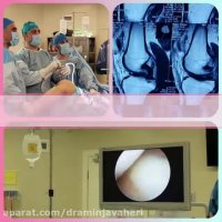 عملیه ترمیم رباط الصلیبی